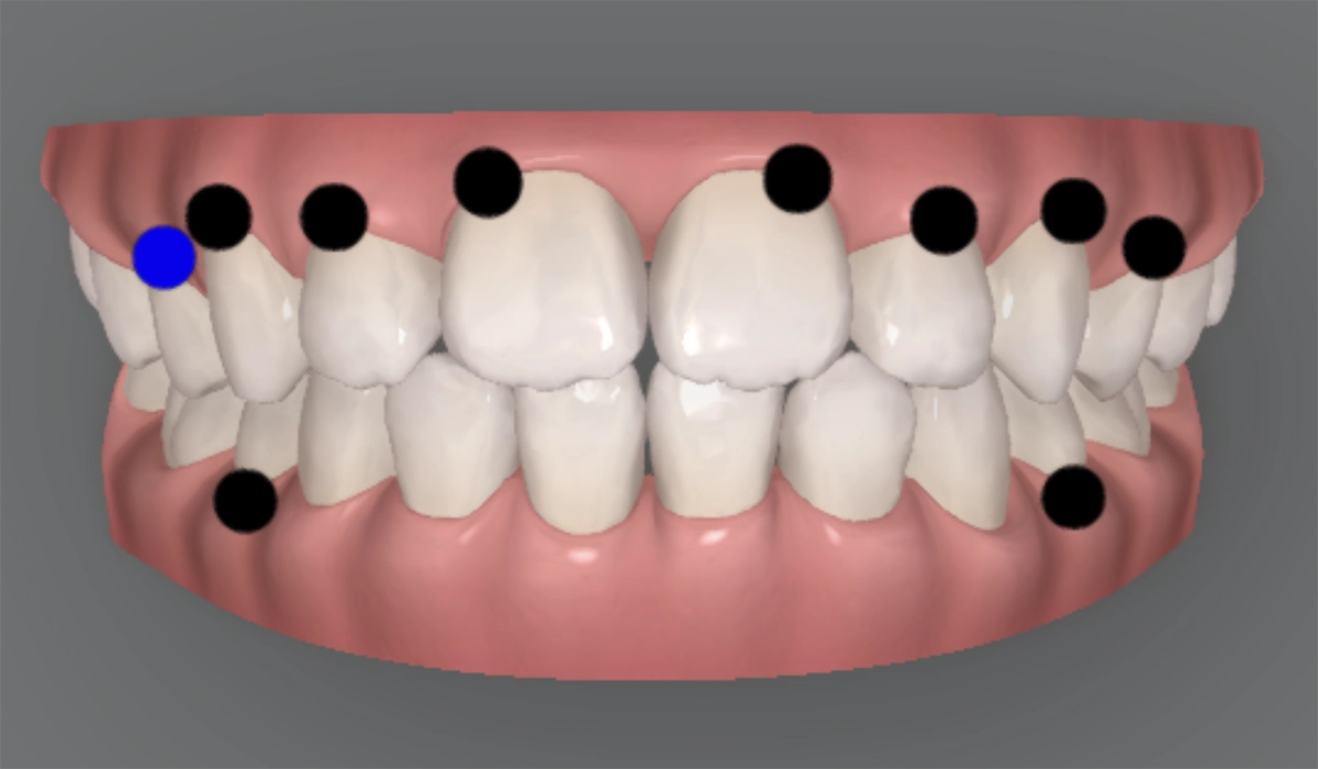 3Dシミュレーションで治療計画を確認できる