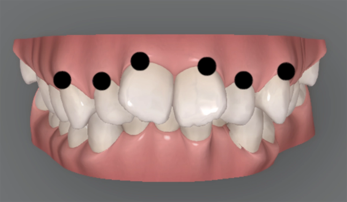インビザライン矯正のシミュレーション
