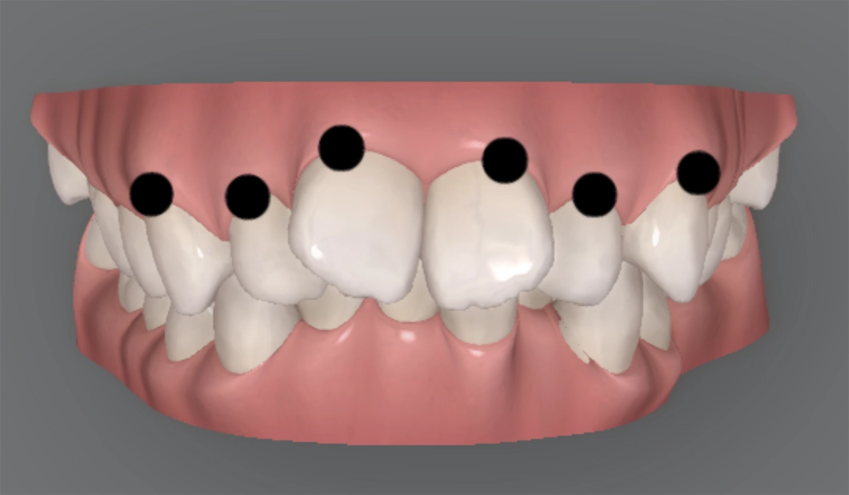 3Dシミュレーションで治療計画を確認できる