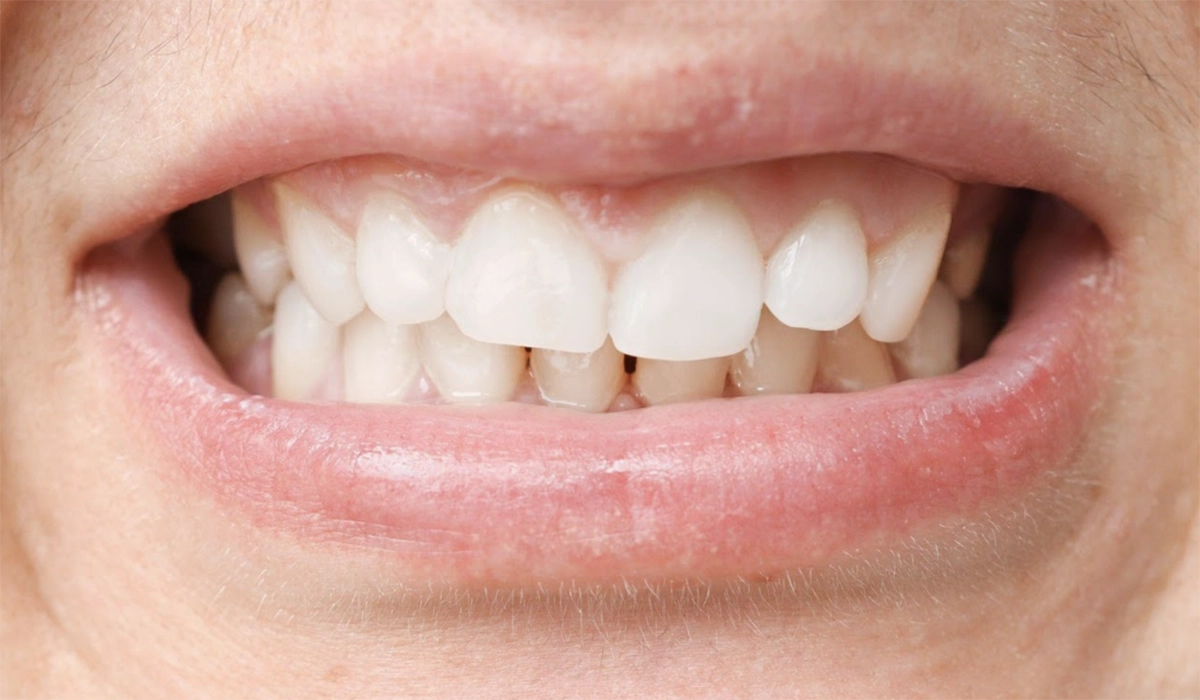 インビザラインで噛み合わせは改善できる?