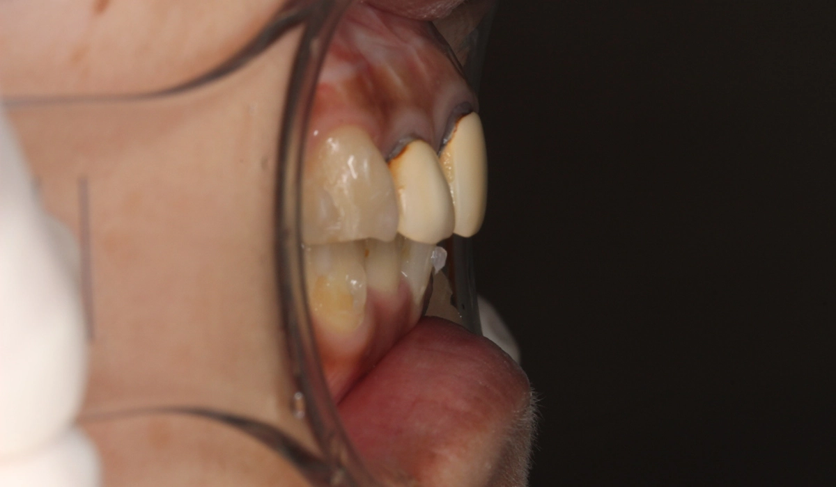 術前オーバージェット