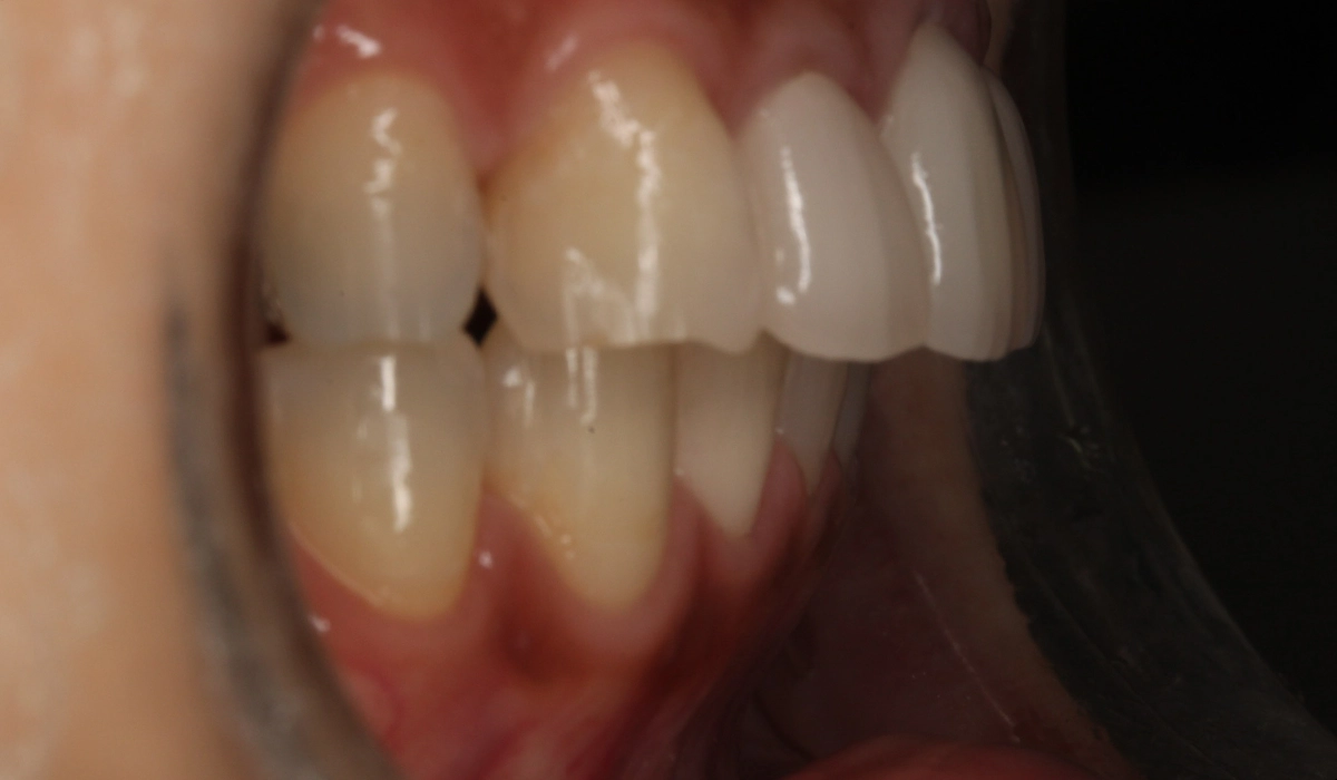 術後オーバージェット