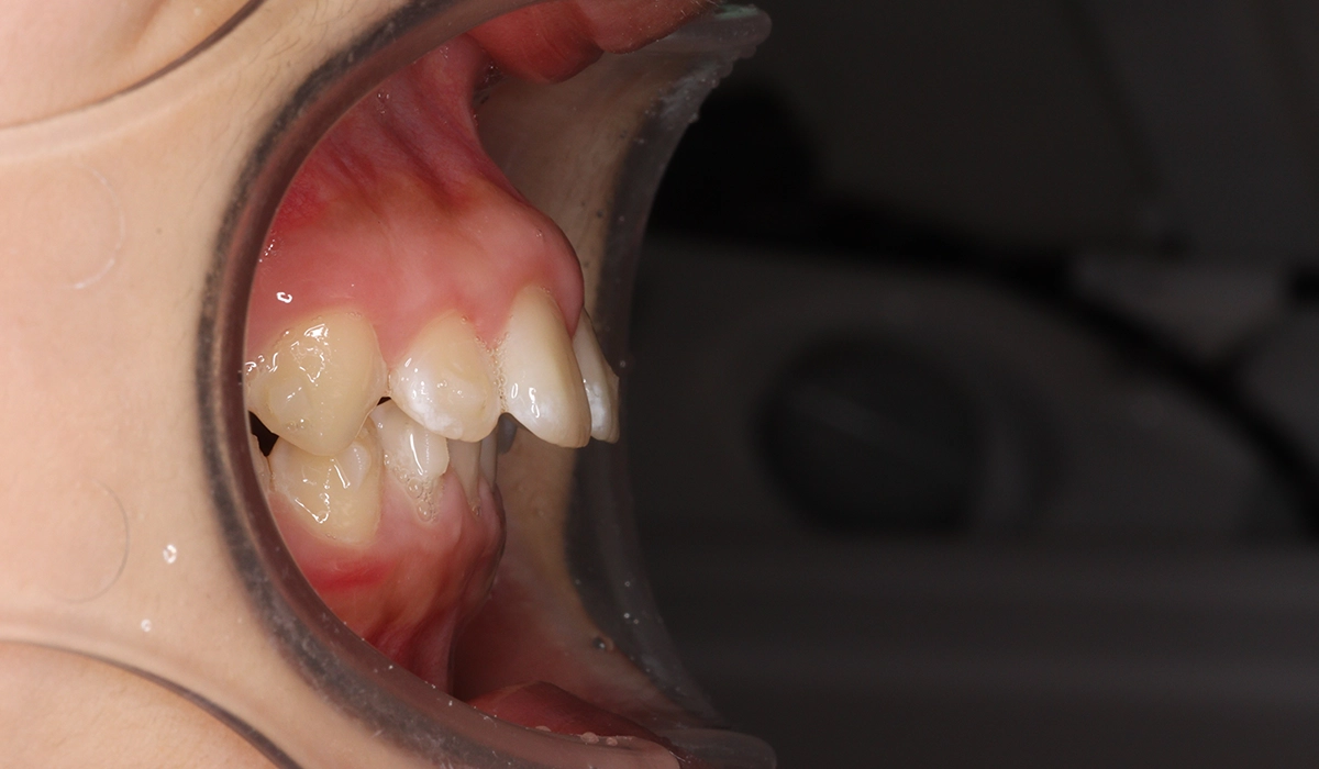 術前:オーバージェット