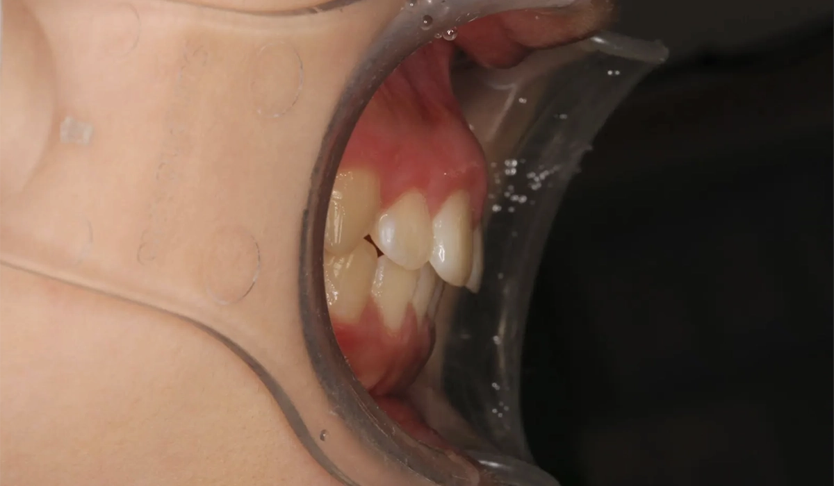 術後:オーバージェット