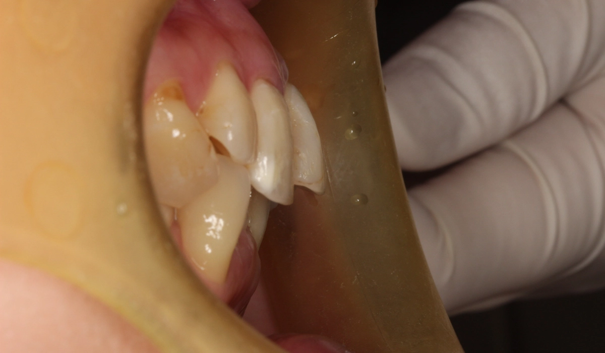 術前:オーバージェット