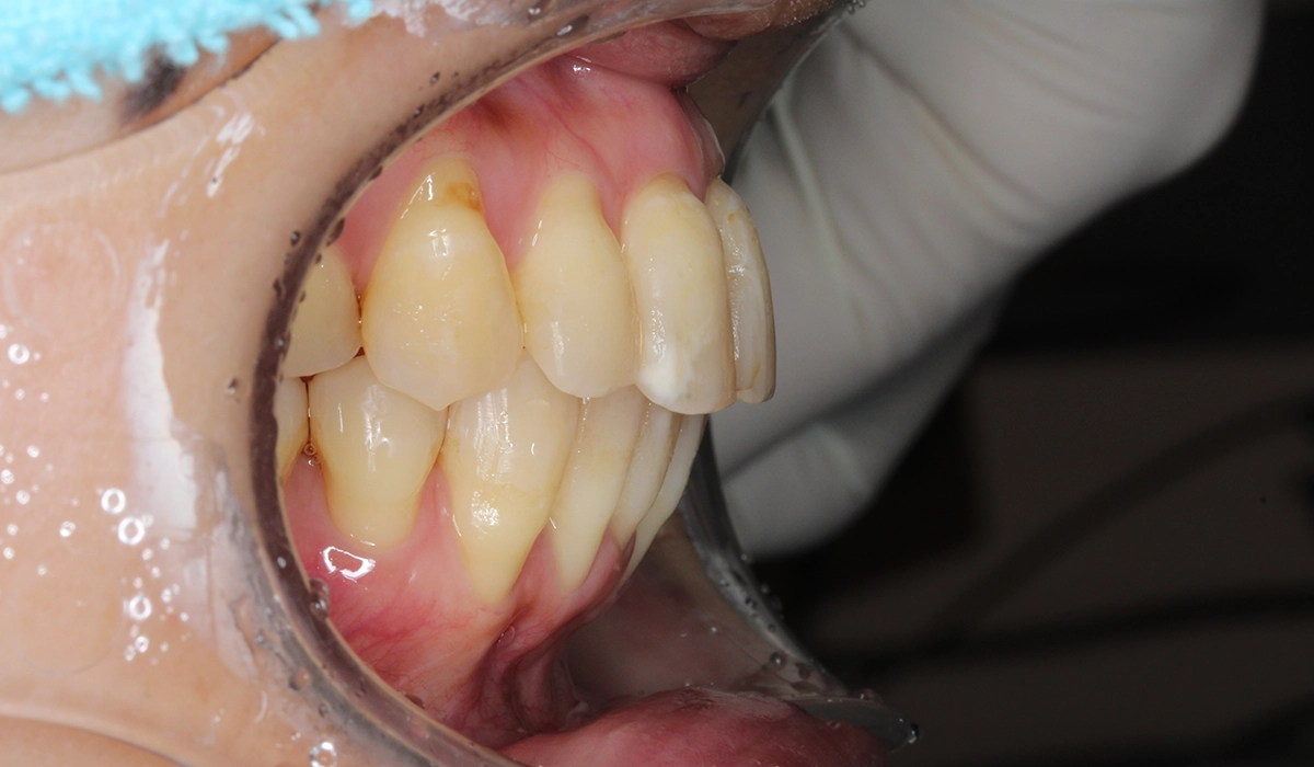 術後:オーバージェット