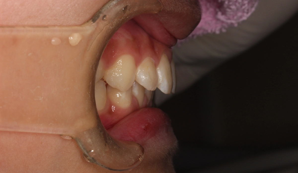 術前:オーバージェット