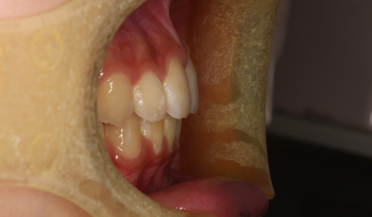 術後:オーバージェット