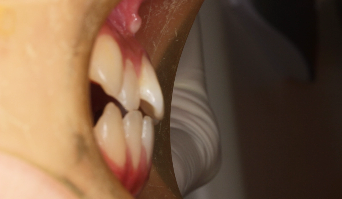 術前:オーバージェット