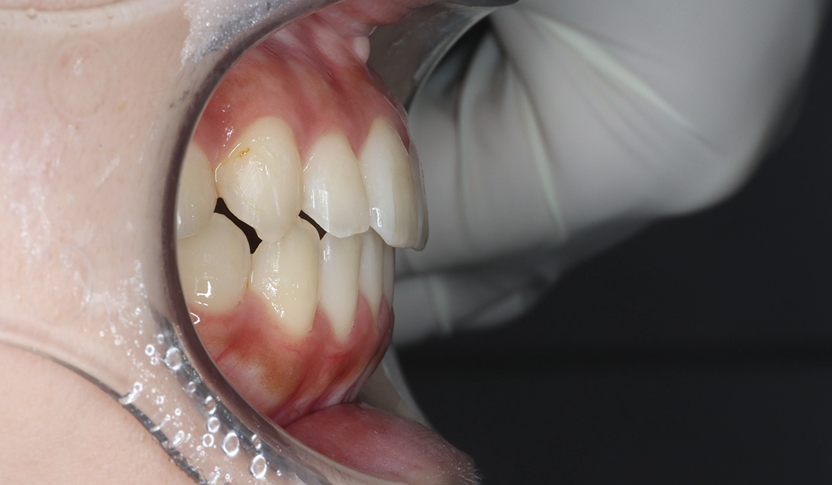 術後:オーバージェット