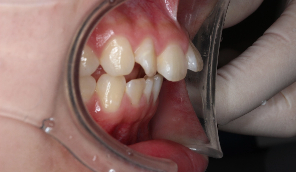 術前:オーバージェット