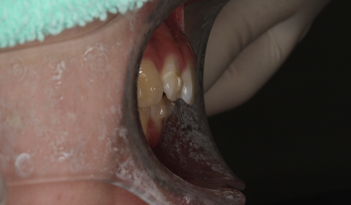 術後:オーバージェット