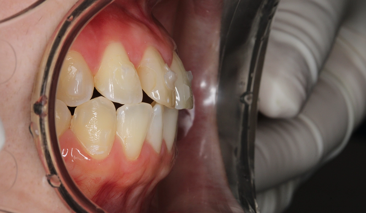 術前:オーバージェット