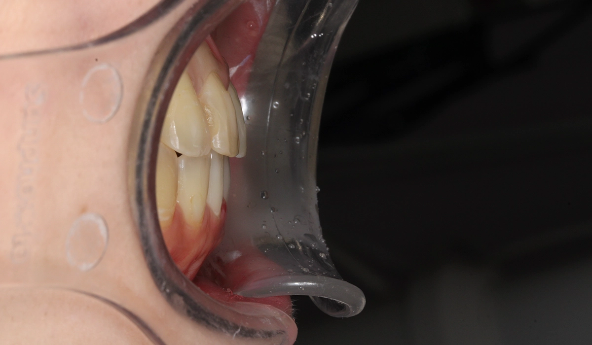 術後:オーバージェット