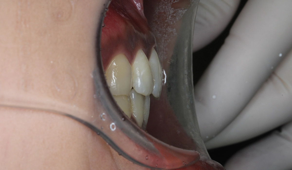 術前:オーバージェット