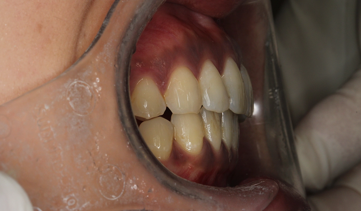 術後:オーバージェット