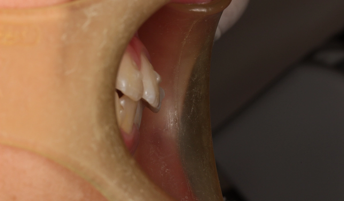 術前:オーバージェット