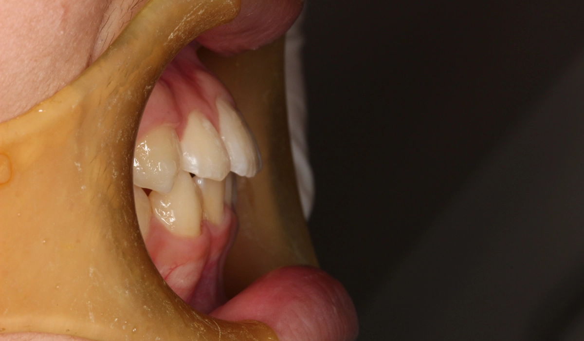 術後:オーバージェット