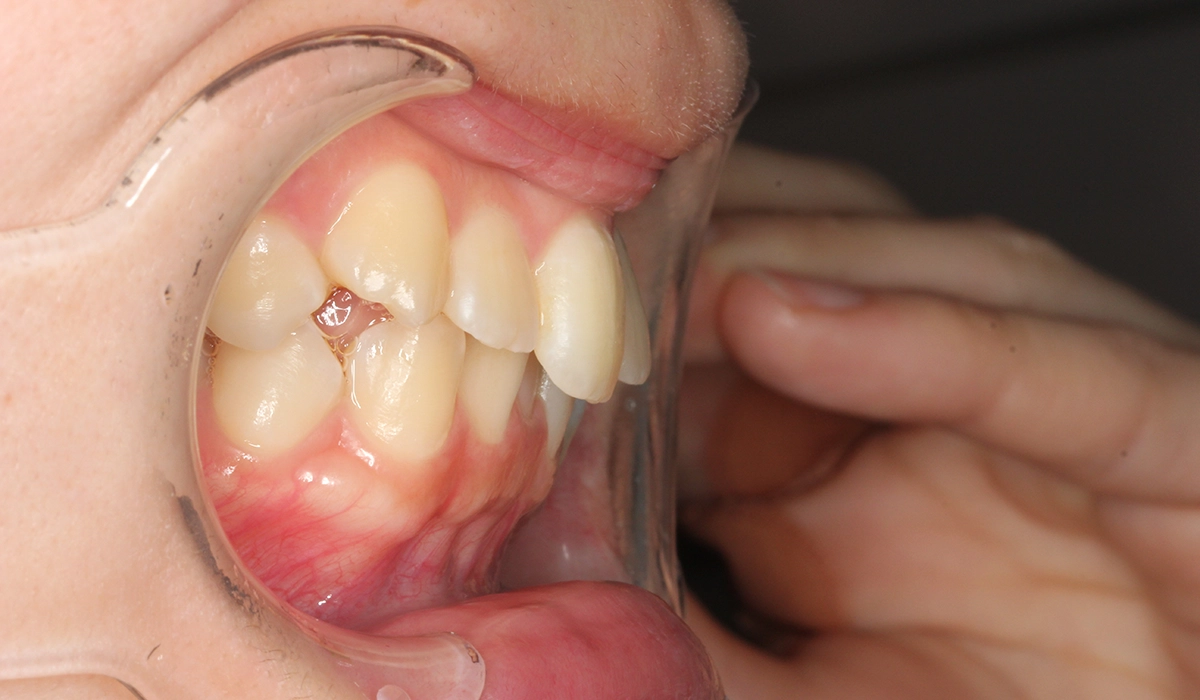 術前:オーバージェット