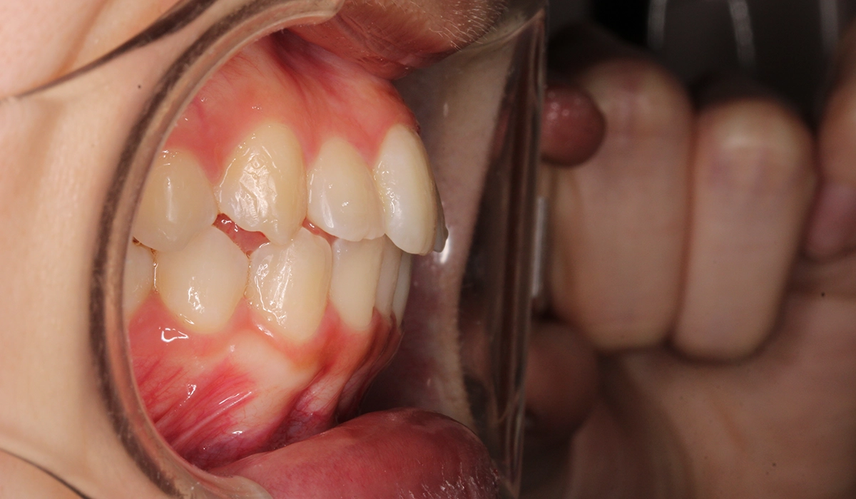 術後:オーバージェット