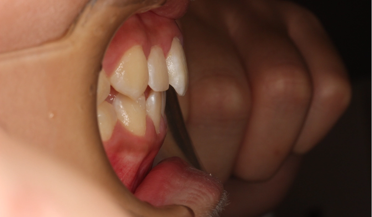 術前：オーバージェット