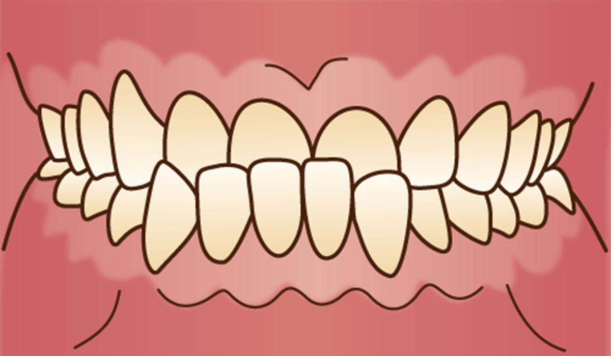 ②受け口(下顎前突)