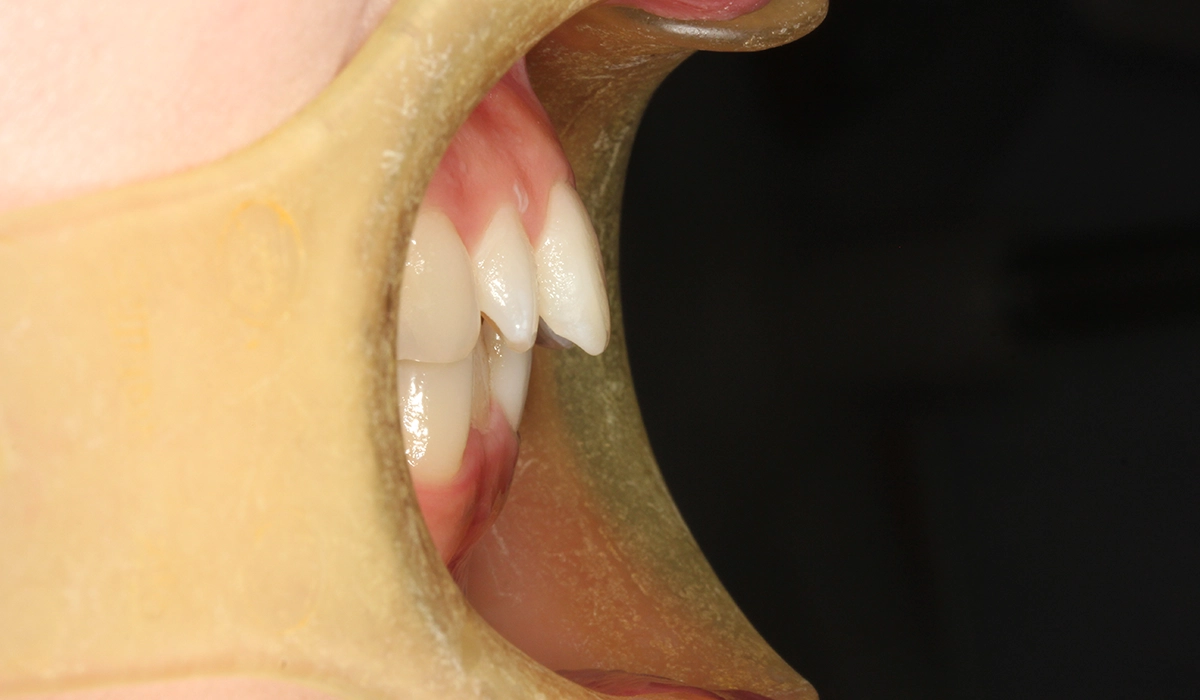 術前:オーバージェット