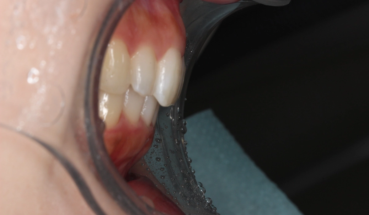 術後:オーバージェット