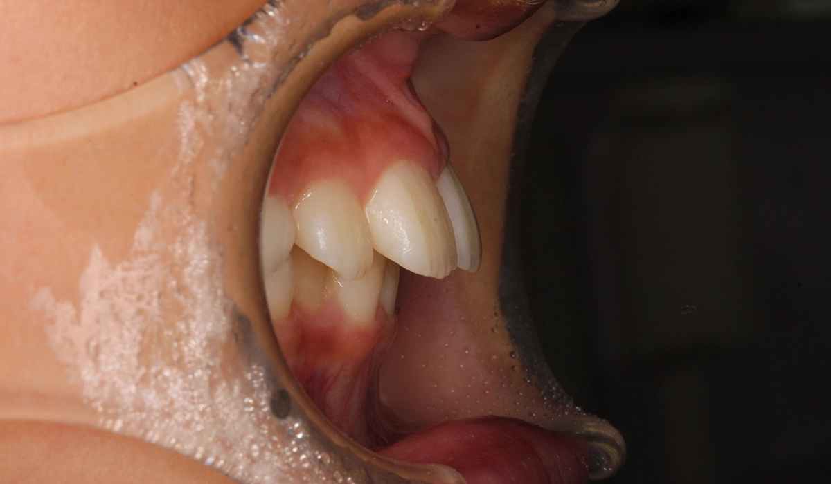 術前:オーバージェット