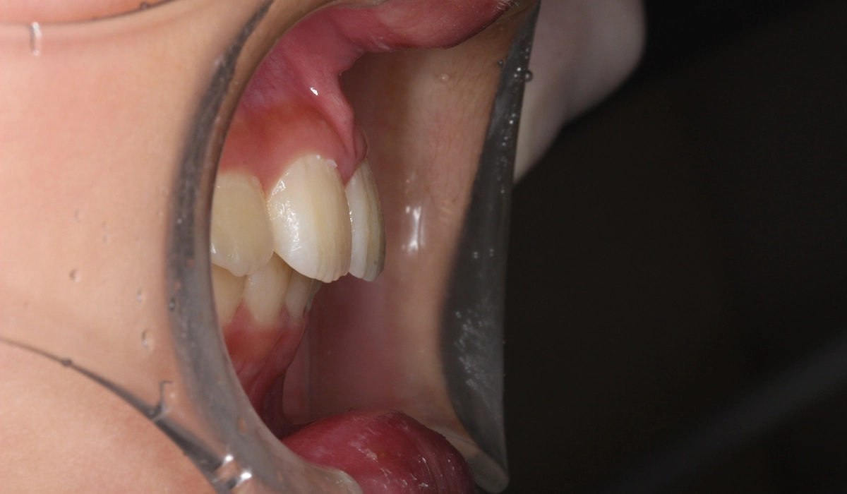 術後:オーバージェット