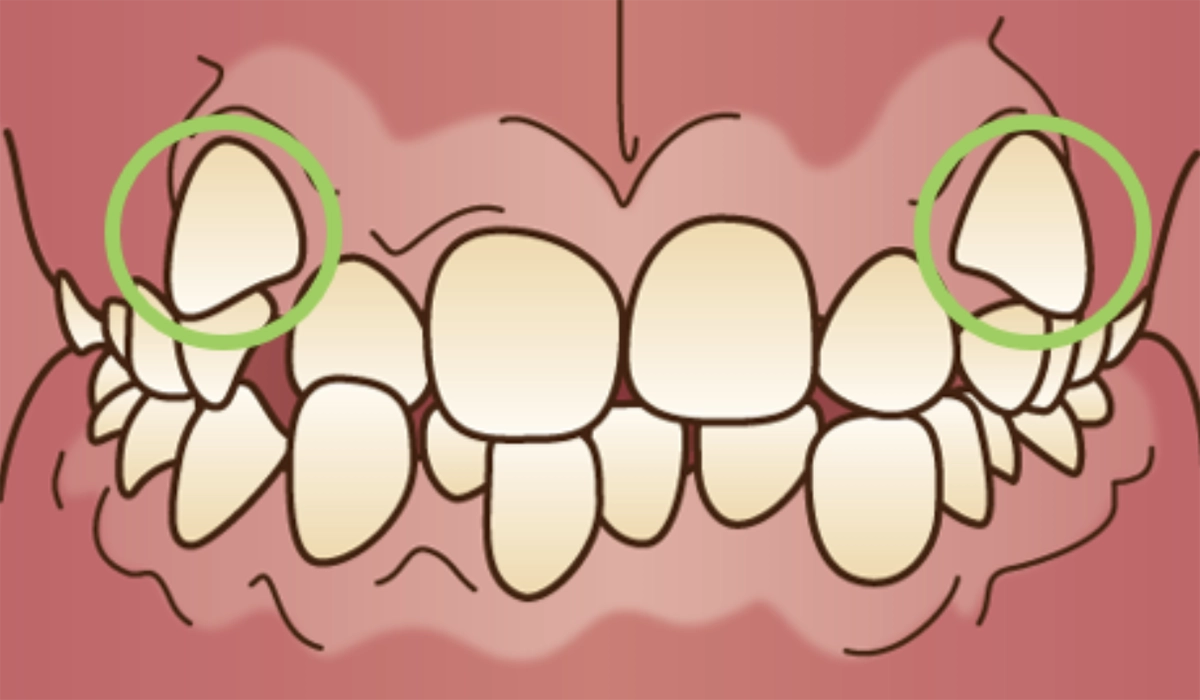 そもそも八重歯とは