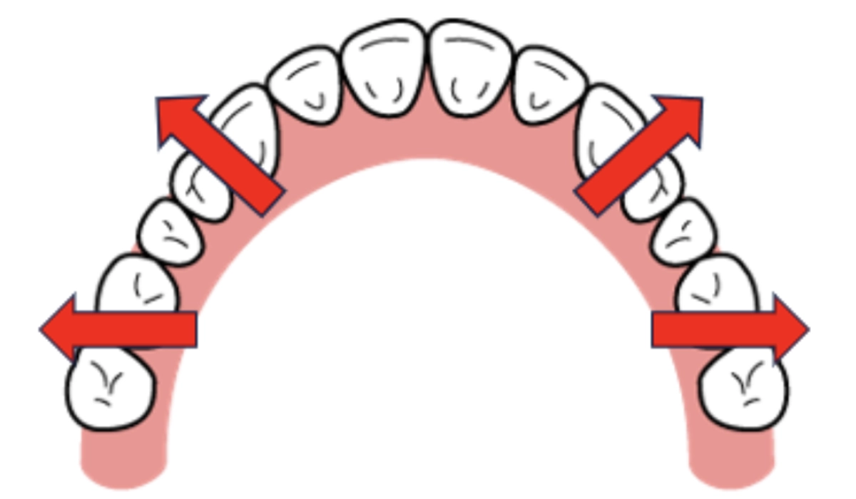 歯列の側方拡大