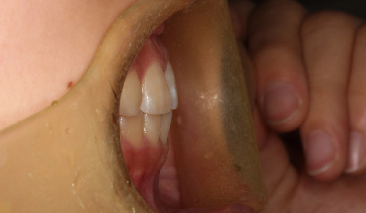 術前:オーバージェット