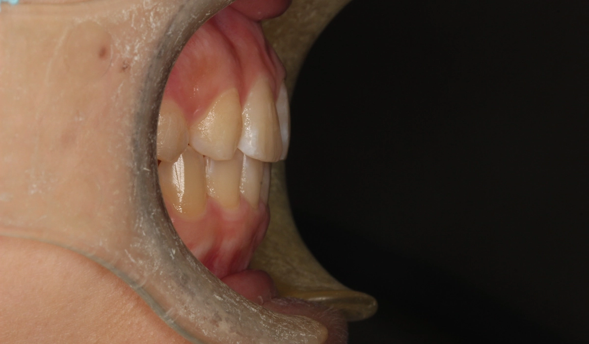 術後:オーバージェット