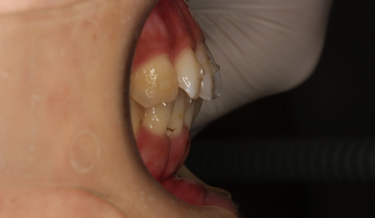 術前:オーバージェット