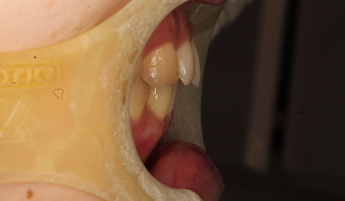 術後:オーバージェット