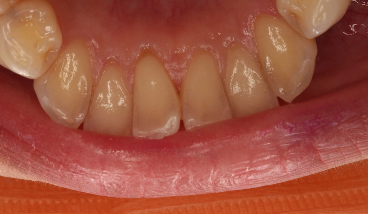 術前:下顎前歯部寄り