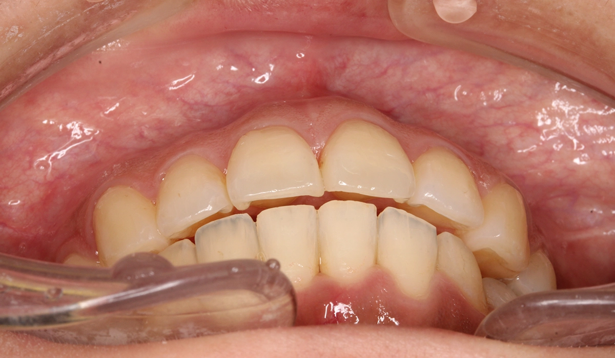 術後:前歯部あおり