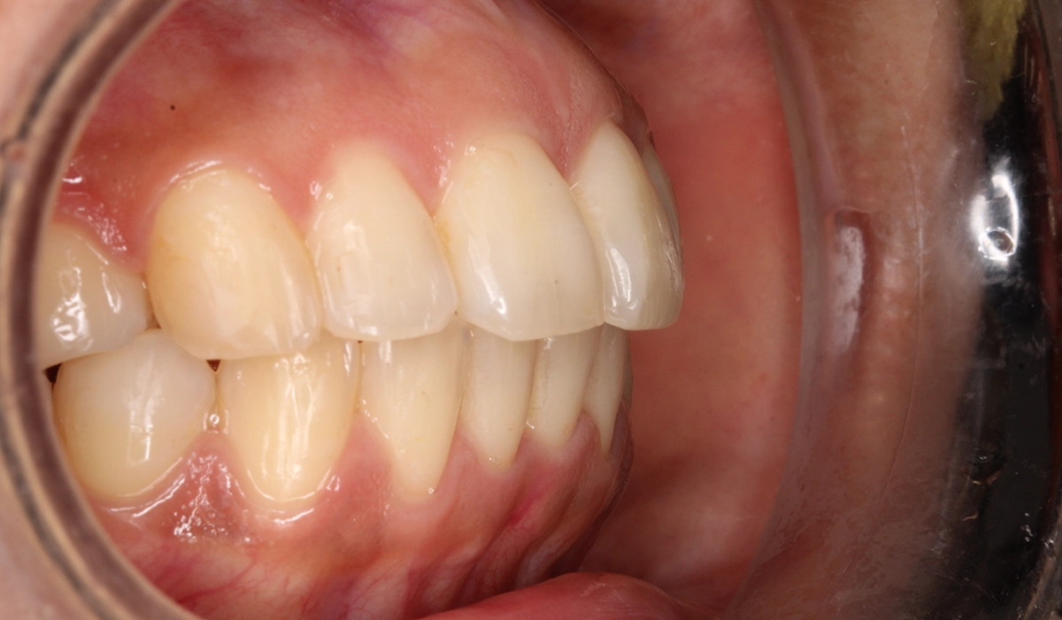 術後:オーバージェット