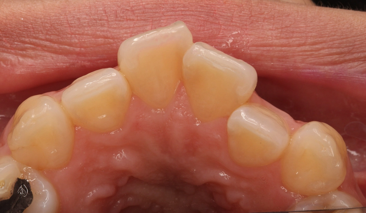 術前:上顎前歯部寄り