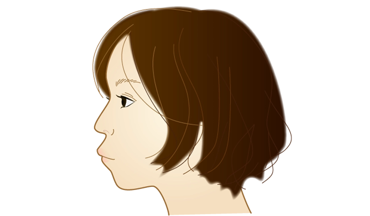 ③口ゴボ(上下顎前突)