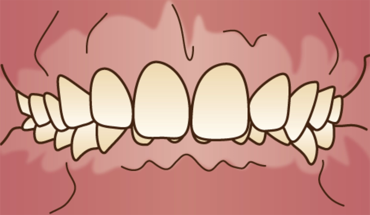 そもそも過蓋咬合とは