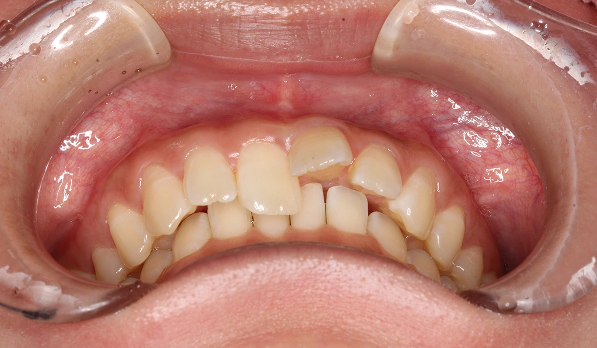 術前：前歯部あおり