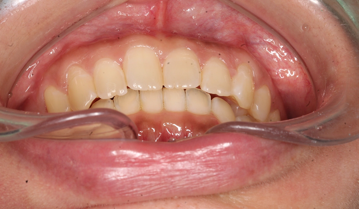 術後：前歯部あおり