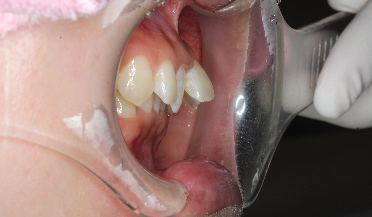 術前：オーバージェット