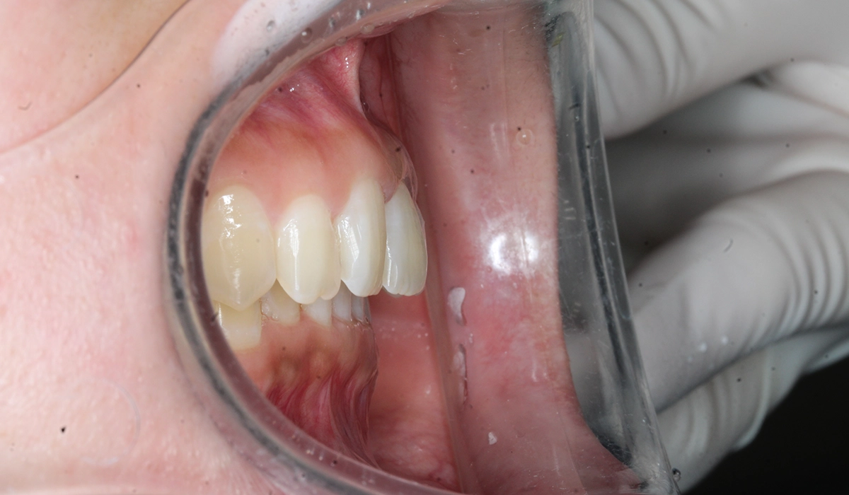 術後：オーバージェット