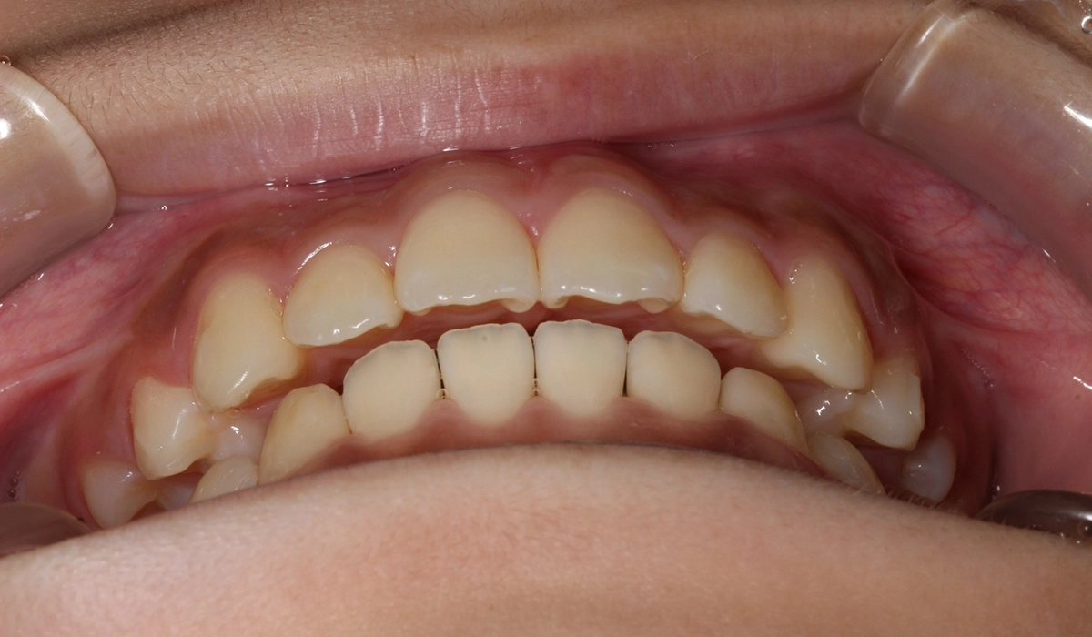 術後:前歯部あおり