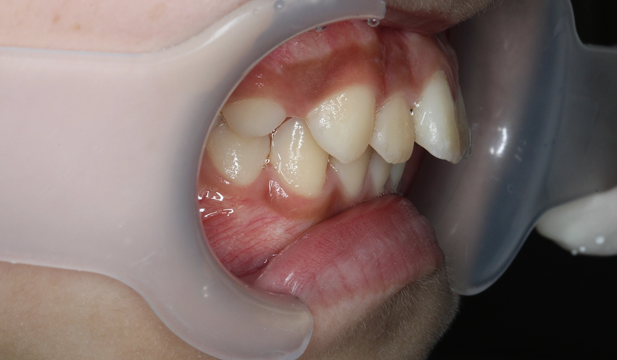 術前:オーバージェット