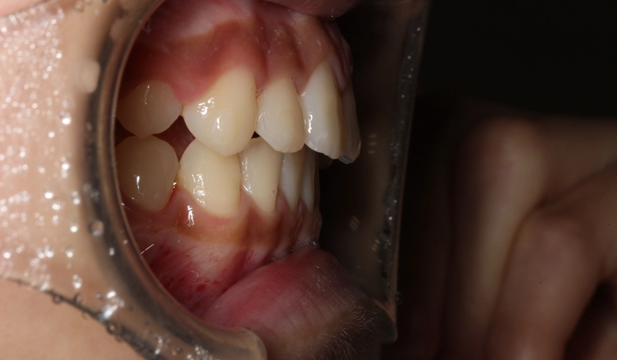 術後:オーバージェット