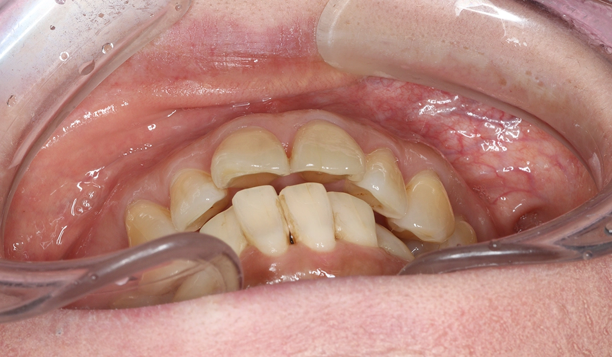 術前:前歯部あおり